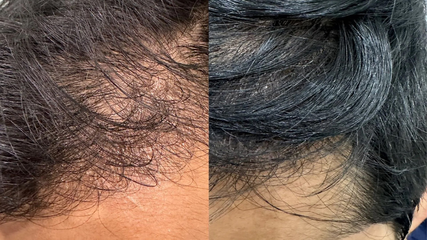 Understanding Alopecia: Types and Treatments from a Functional Medicine Perspective
